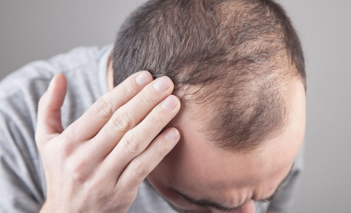 The Science of Baldness Why We Lose Hair and How We Might Regrow It